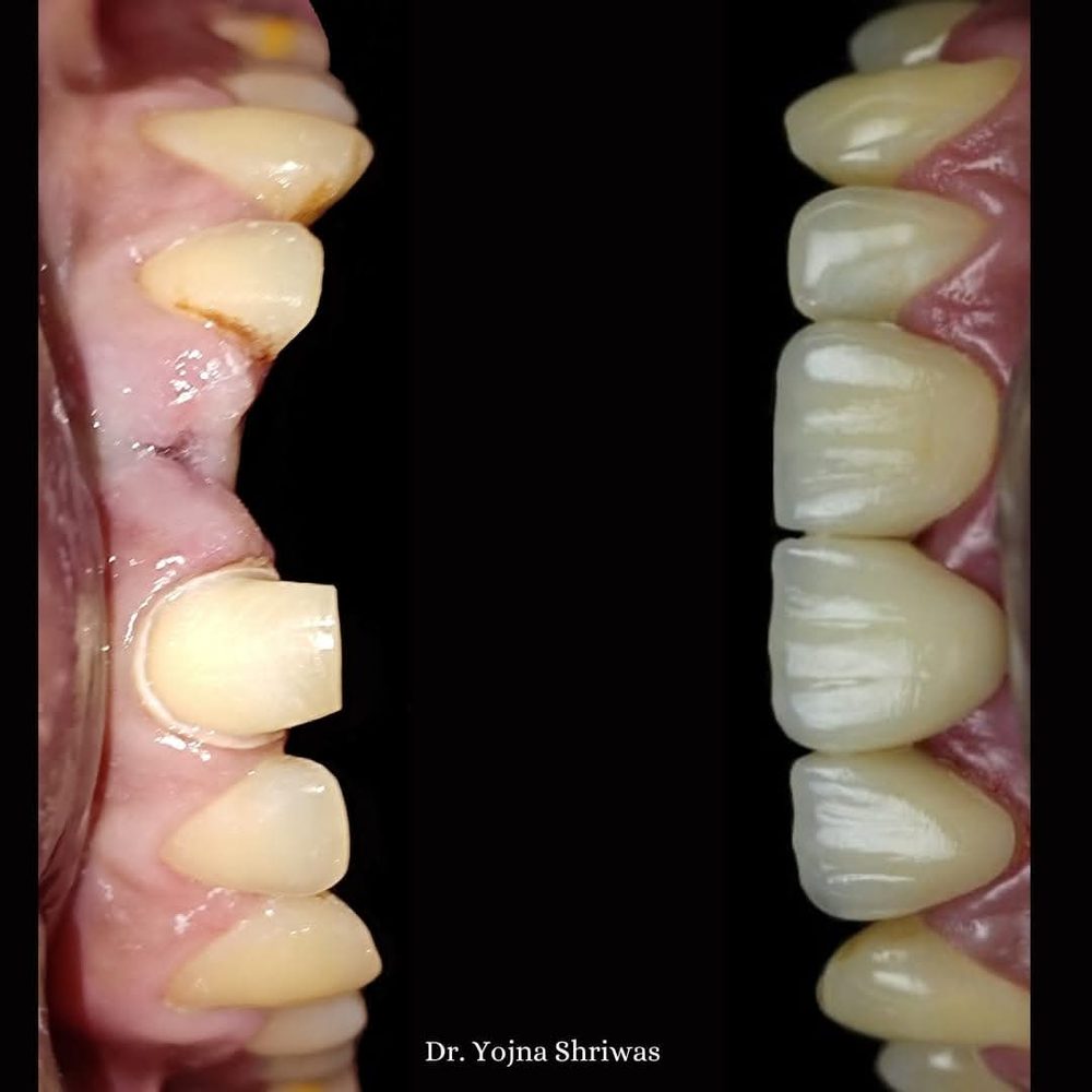Aesthetic Crown — before and after result, Dr. Yojna's Dental Clinic, Jaipur