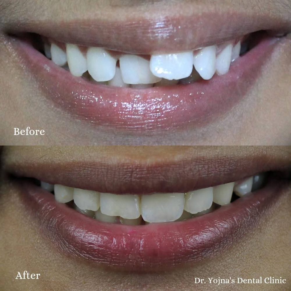 Braces — before and after result, Dr. Yojna's Dental Clinic, Jaipur