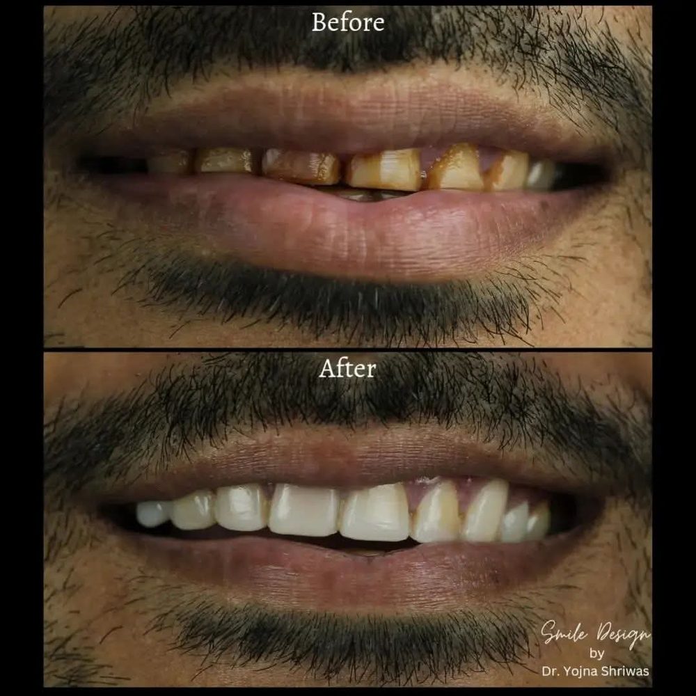Composite Veneers — before and after result, Dr. Yojna's Dental Clinic, Jaipur