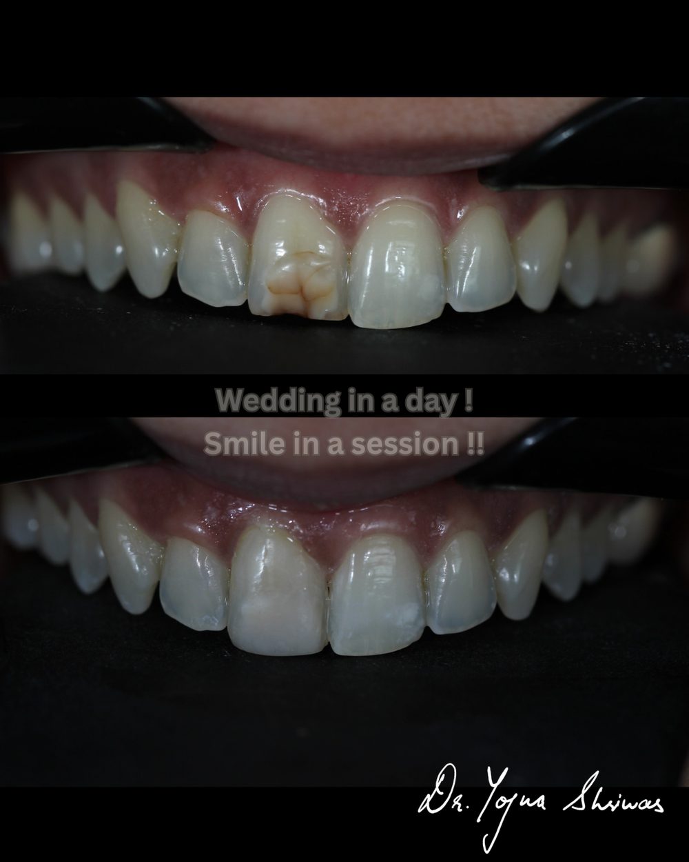 Composite Veneers — before and after result, Dr. Yojna's Dental Clinic, Jaipur