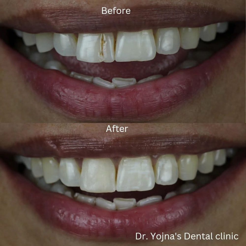 Cosmetic Bonding — before and after result, Dr. Yojna's Dental Clinic, Jaipur
