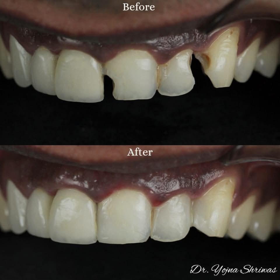 Cosmetic Bonding — before and after result, Dr. Yojna's Dental Clinic, Jaipur