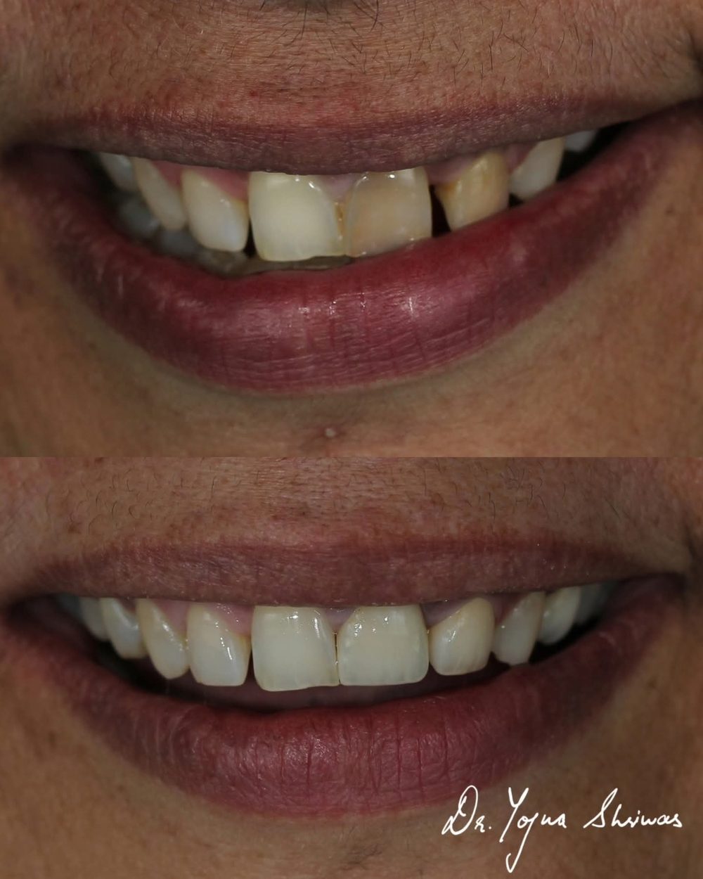 Teeth Whitening — before and after result, Dr. Yojna's Dental Clinic, Jaipur