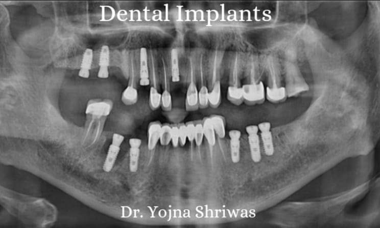 Full-Mouth Implants — before and after result, Dr. Yojna's Dental Clinic, Jaipur