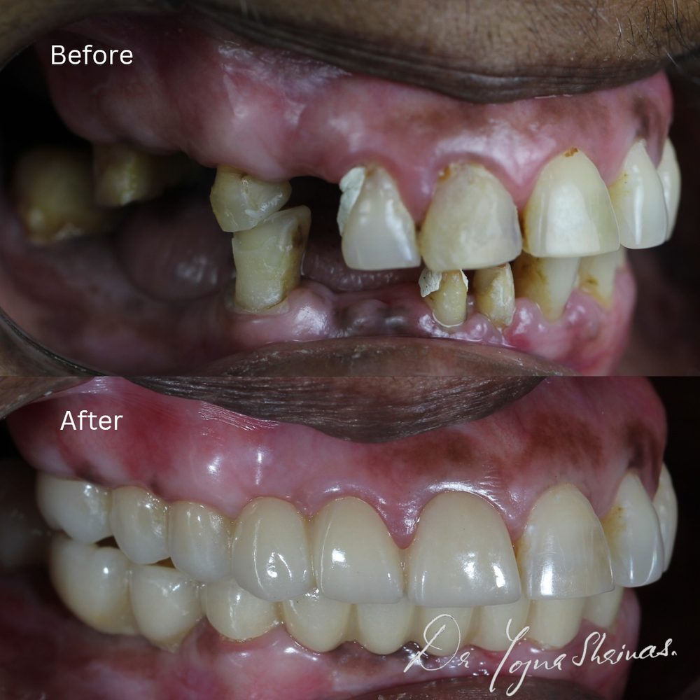 Full Mouth Rehabilitation — before and after result, Dr. Yojna's Dental Clinic, Jaipur