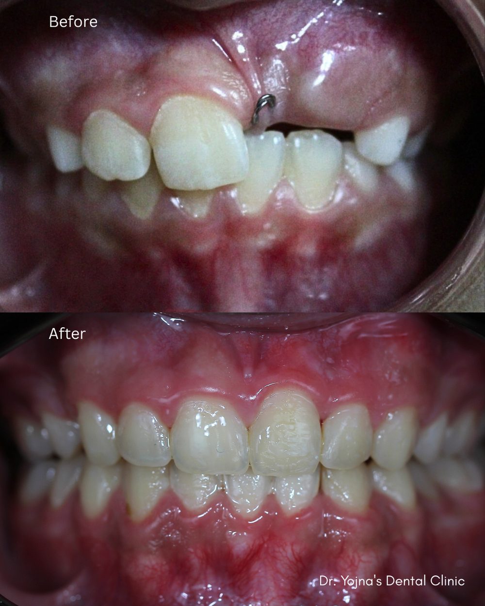 Guided Eruption & Alignment — before and after result, Dr. Yojna's Dental Clinic, Jaipur