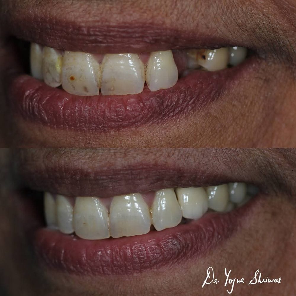 Dental Implant — before and after result, Dr. Yojna's Dental Clinic, Jaipur