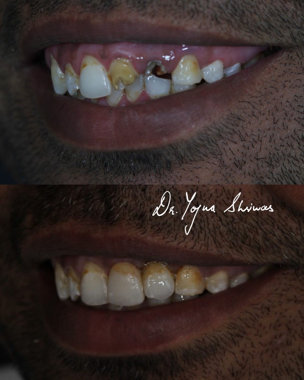 Composite Veneers — before and after result, Dr. Yojna's Dental Clinic, Jaipur