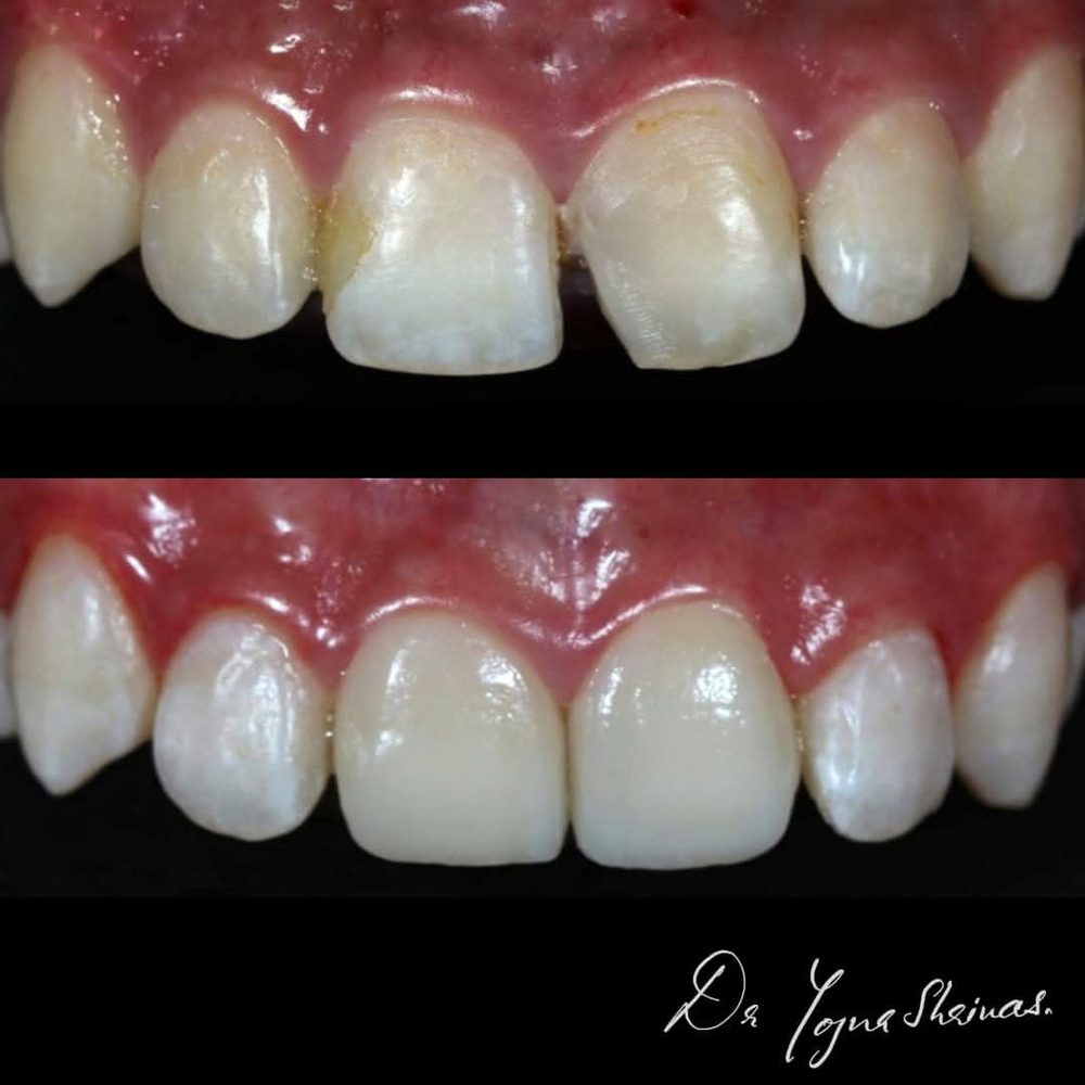 Porcelain Veneers — before and after result, Dr. Yojna's Dental Clinic, Jaipur