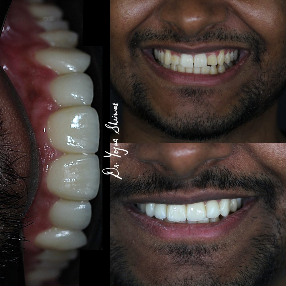Porcelain Veneers — before and after result, Dr. Yojna's Dental Clinic, Jaipur