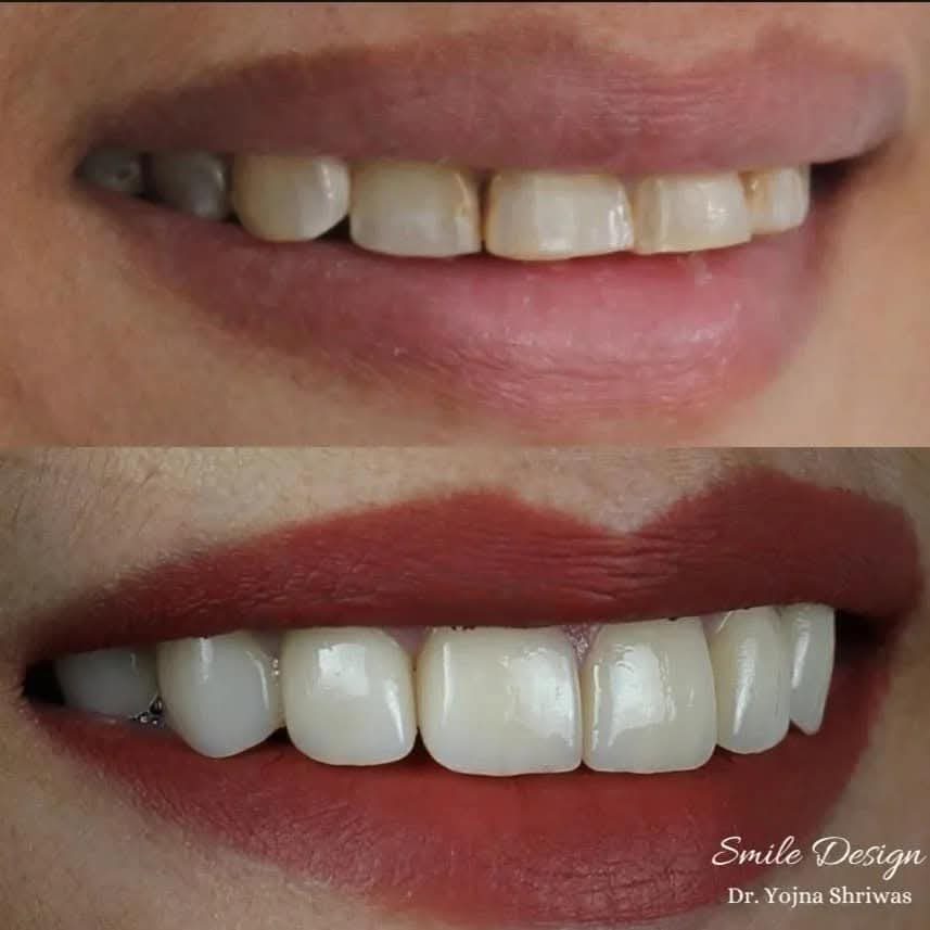 Porcelain Veneers — before and after result, Dr. Yojna's Dental Clinic, Jaipur