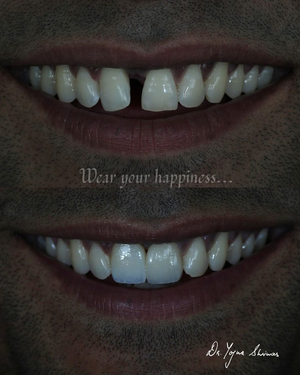 Porcelain Veneers — before and after result, Dr. Yojna's Dental Clinic, Jaipur