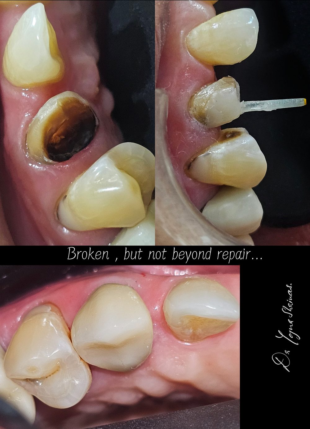 Post & Core — before and after result, Dr. Yojna's Dental Clinic, Jaipur