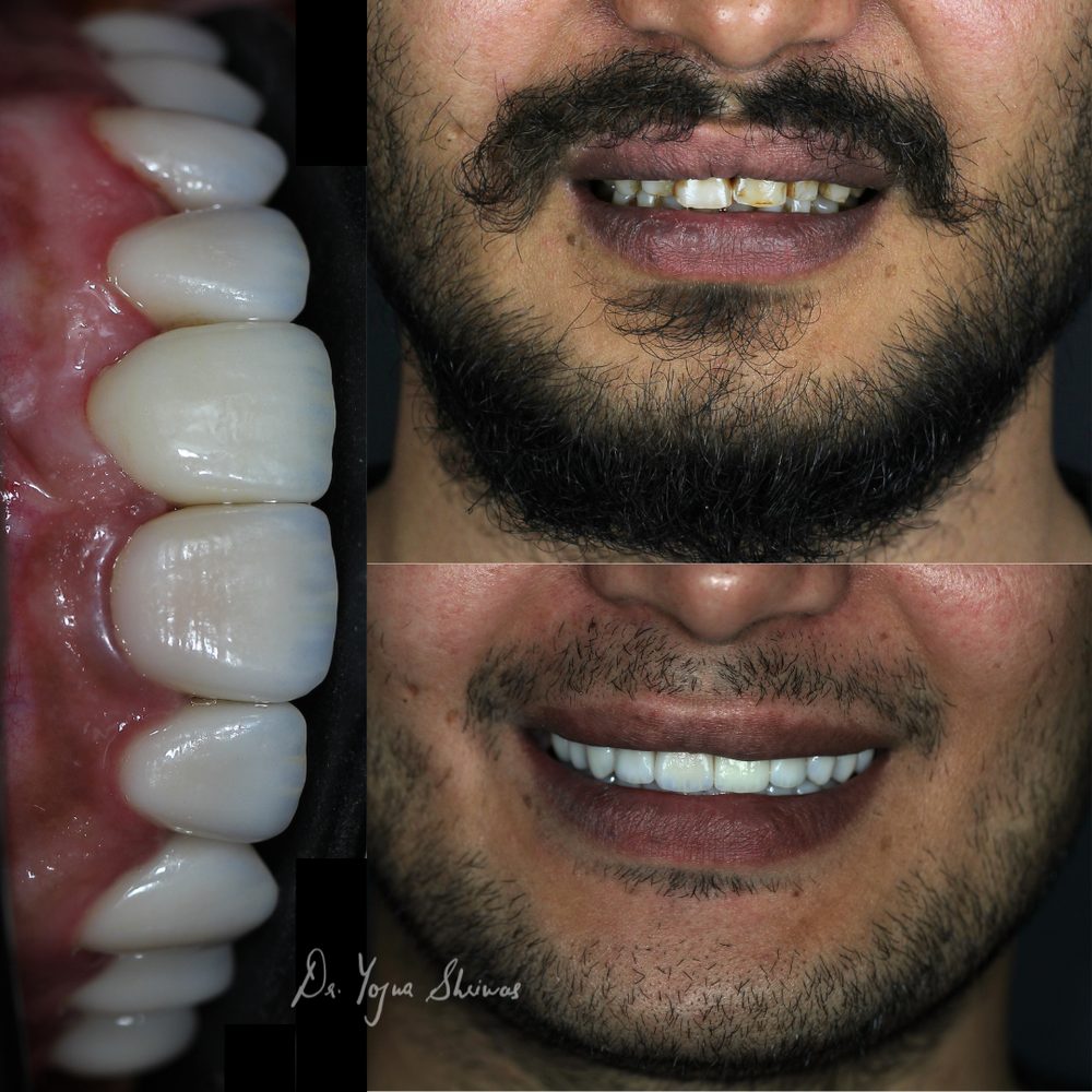 Digital Smile Design — before and after result, Dr. Yojna's Dental Clinic, Jaipur