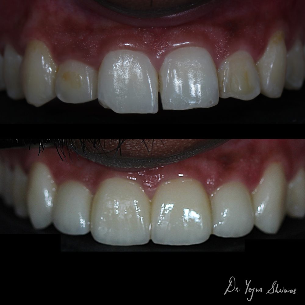 Digital Smile Design — before and after result, Dr. Yojna's Dental Clinic, Jaipur