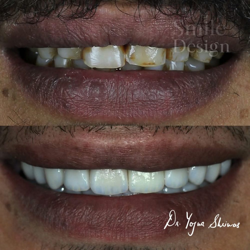 Digital Smile Design — before and after result, Dr. Yojna's Dental Clinic, Jaipur