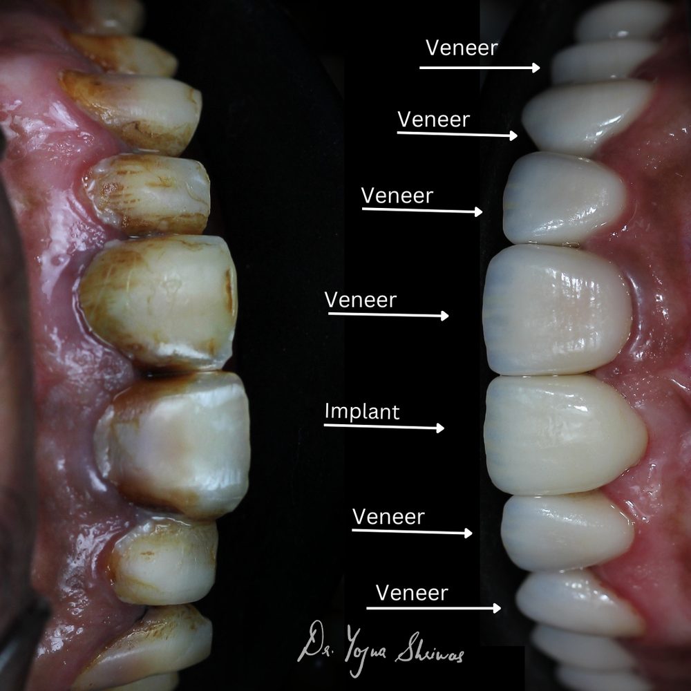 Smile Makeover — before and after result, Dr. Yojna's Dental Clinic, Jaipur