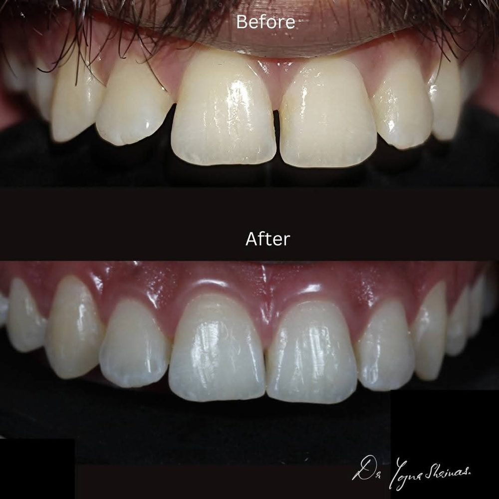Space Closure — before and after result, Dr. Yojna's Dental Clinic, Jaipur