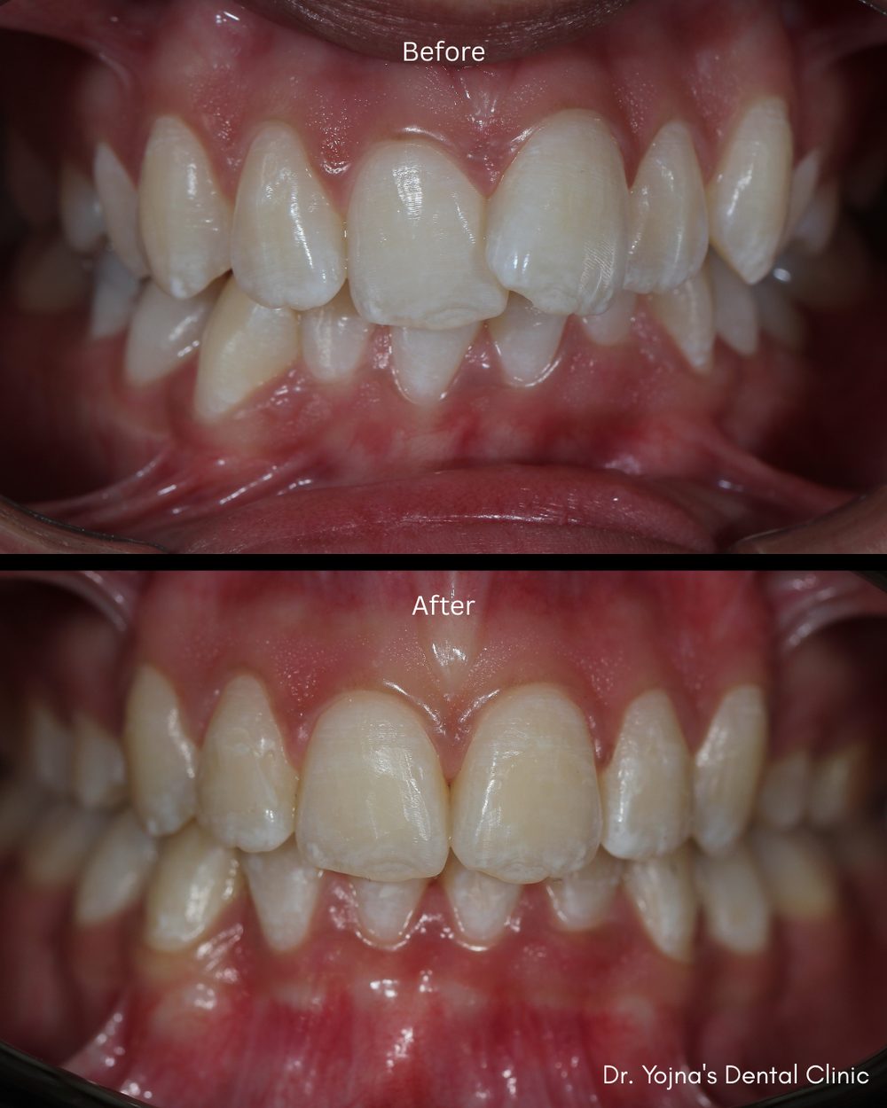 Orthodontic Alignment — before and after result, Dr. Yojna's Dental Clinic, Jaipur