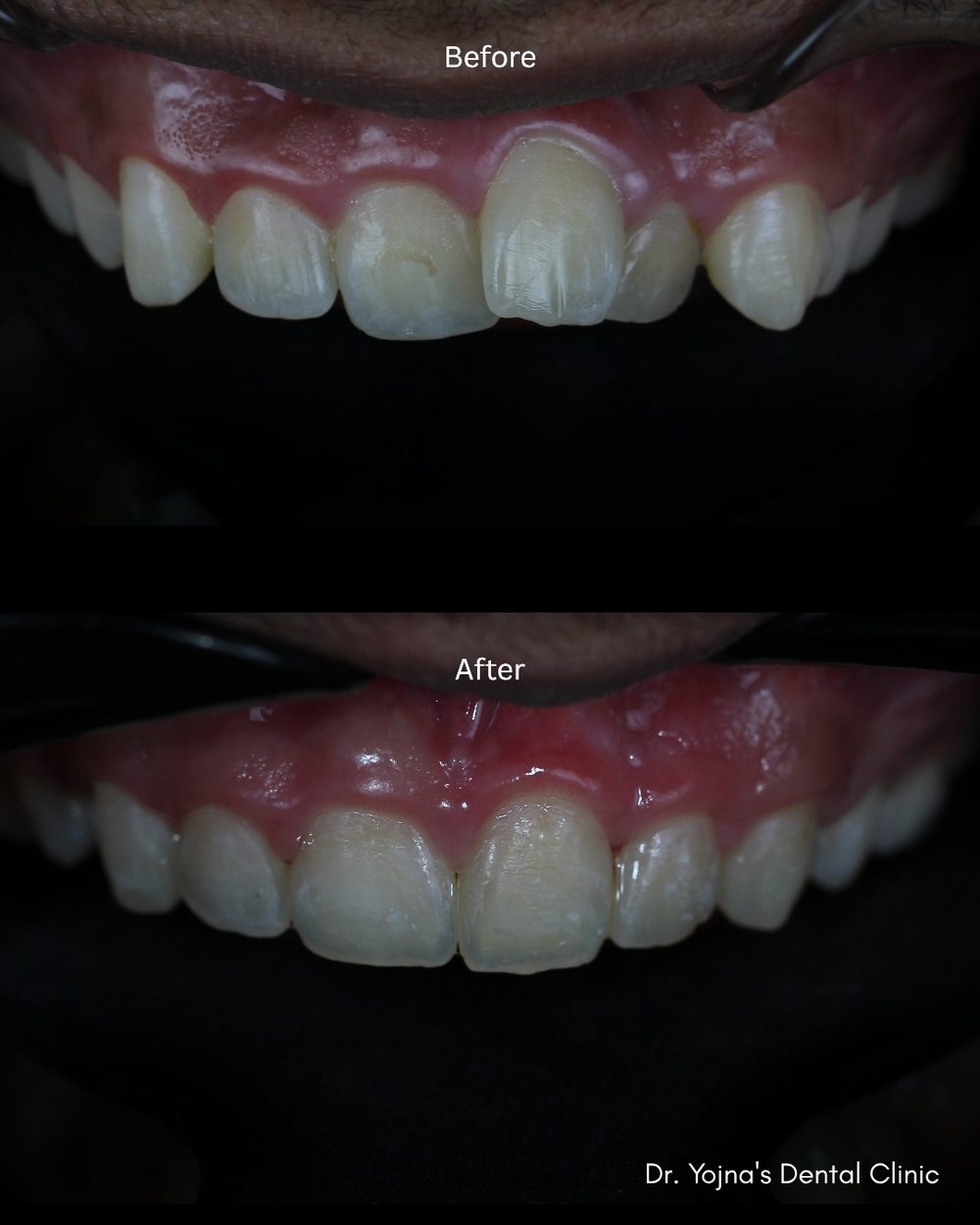 Orthodontic Alignment — before and after result, Dr. Yojna's Dental Clinic, Jaipur