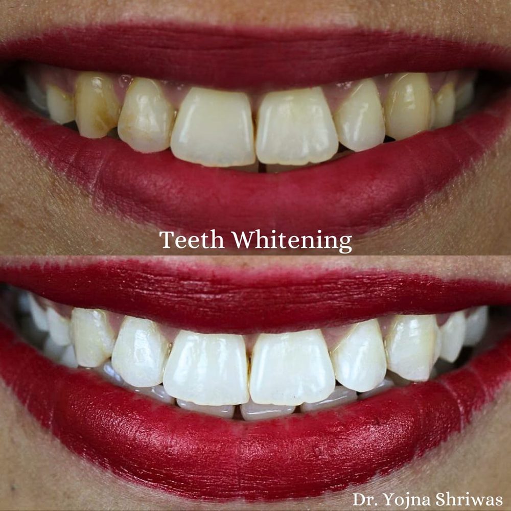 Teeth Whitening — before and after result, Dr. Yojna's Dental Clinic, Jaipur
