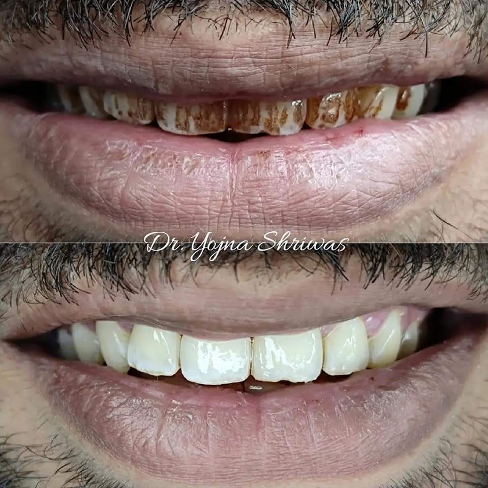 Teeth Whitening — before and after result, Dr. Yojna's Dental Clinic, Jaipur