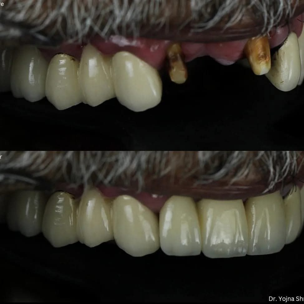 Zirconia Crowns — before and after result, Dr. Yojna's Dental Clinic, Jaipur